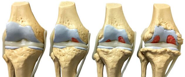 lésions articulaires aux différents stades de développement de l'arthrose de la cheville