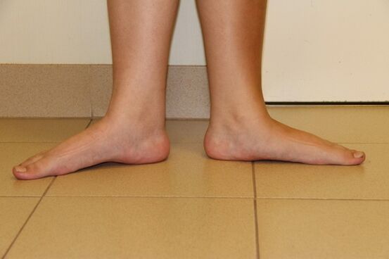 Parfois, la cause de l’arthrite du cou est les pieds plats