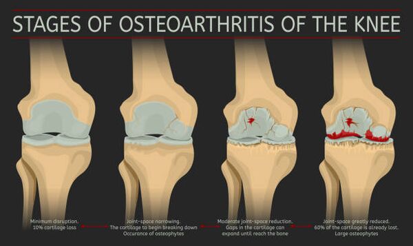 développement de l'arthrose articulaire