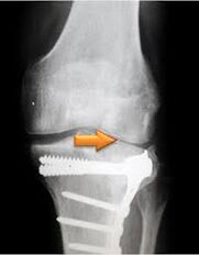 arthrose de l'articulation du genou