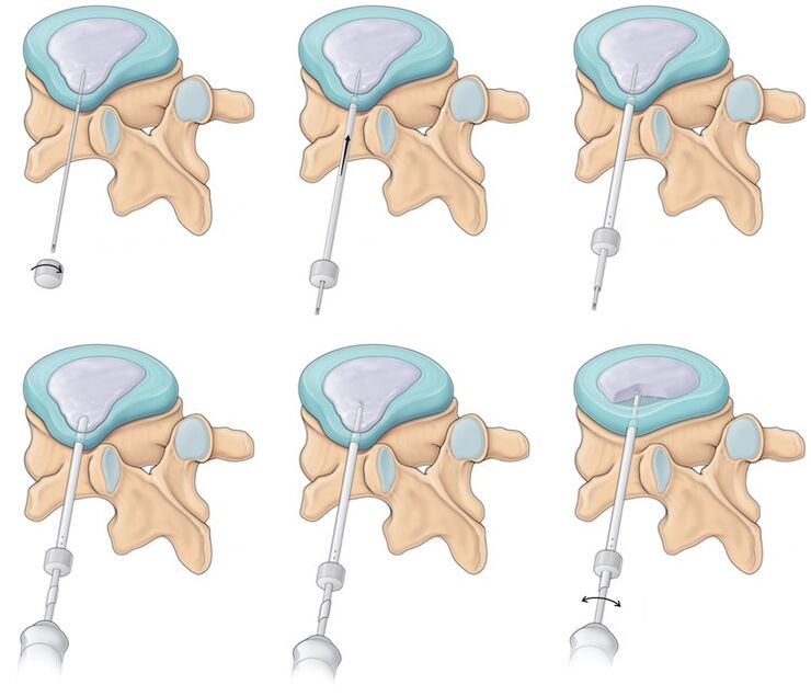 chirurgie pour mal de dos