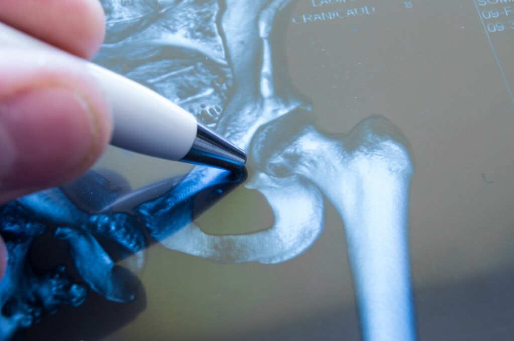 Arthrose de l'articulation de la hanche à la radiographie