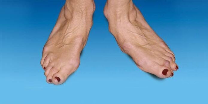 déformation du pied avec arthrose de la cheville