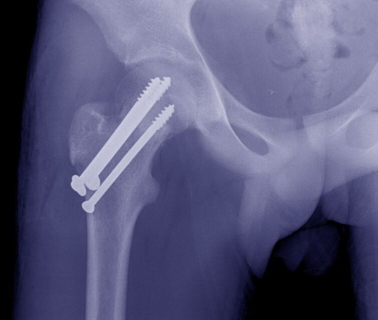 Radiographie de l'articulation de la hanche, ostéosynthèse de la fracture avec des dispositifs de fixation interne
